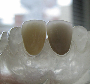 クラウン（かぶせもの）白いきれいな歯をより安く-上領歯科医院
